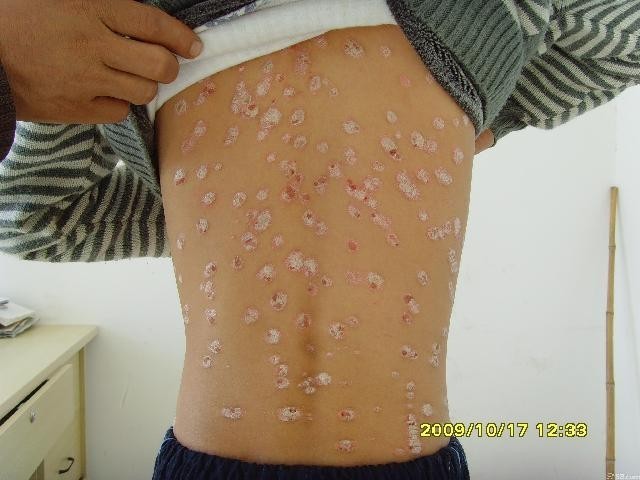 武汉白癜风专家详解白癜风病因