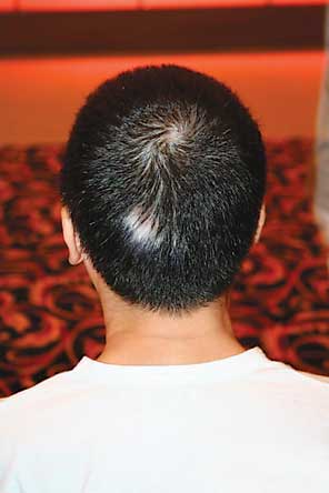 完全型白癜风该怎样治疗